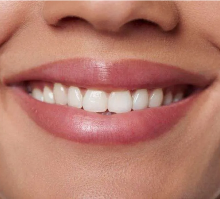 Various causes of white spots on teeth and methods of treatment and prevention