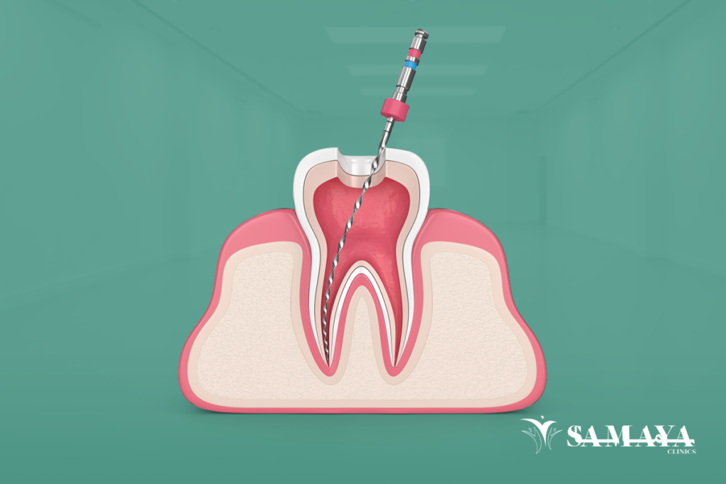 علاج جذور الاسنان