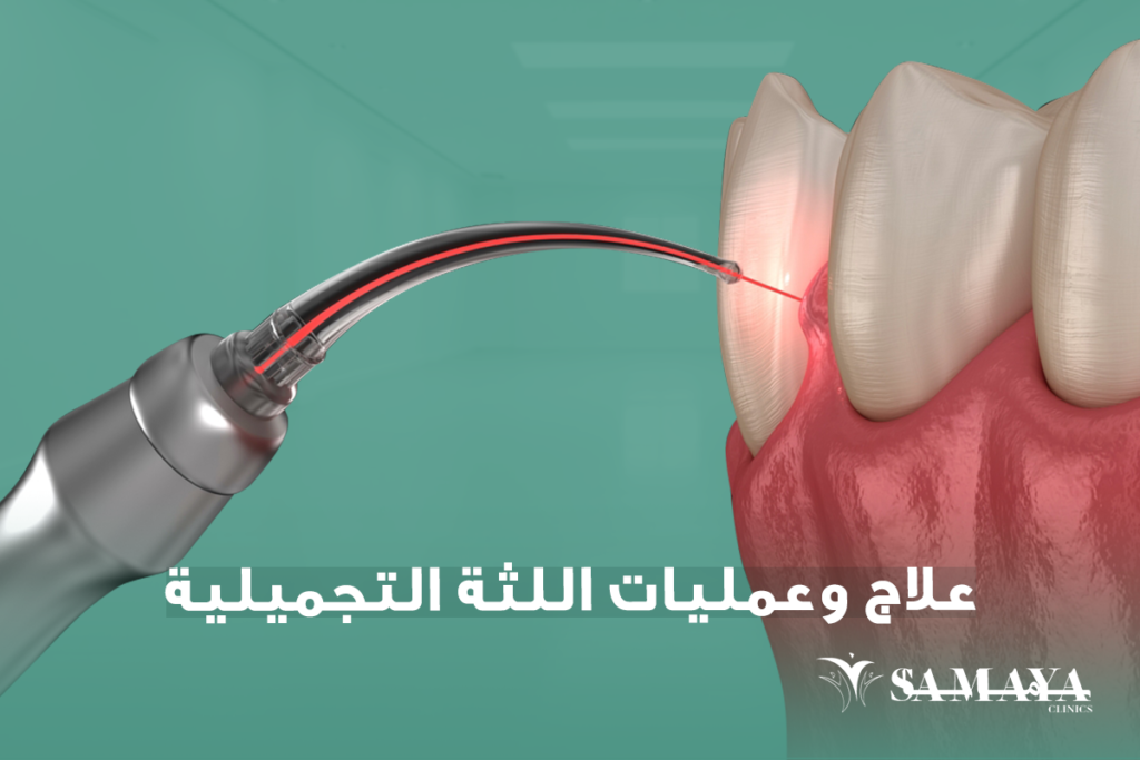 عمليات اللثة التجميلية