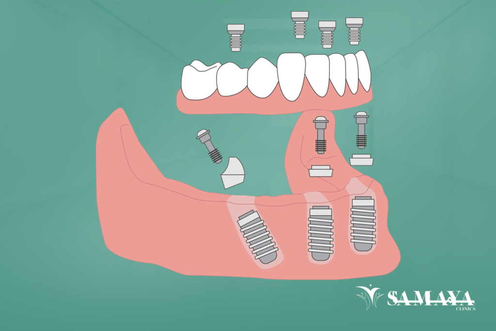 زراعة الاسنان الفورية في السعودية