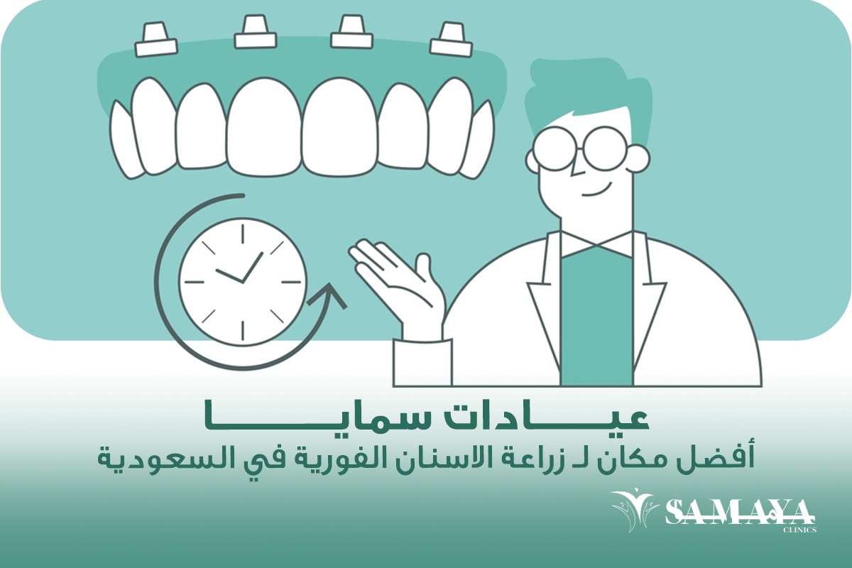 عيادات سمايا :أفضل مكان لـ زراعة الاسنان الفورية في السعودية