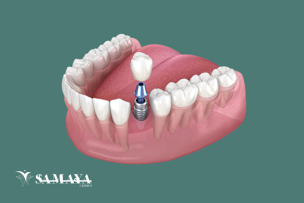 زراعة الاسنان في جدة