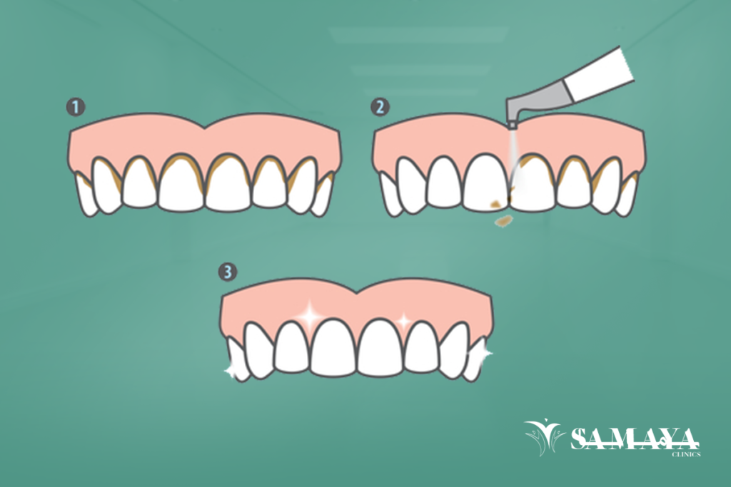 تنظيف عميق للاسنان